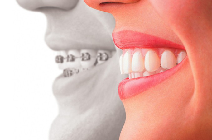 Image of a comparison between braces and Invisalign