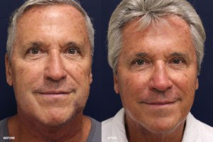 Dr. Andre Berger Before and After Gallery at Rejuvalife Vitality Institute