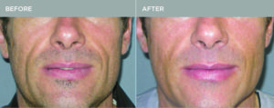 Bellafill Man's Mouth Before and After