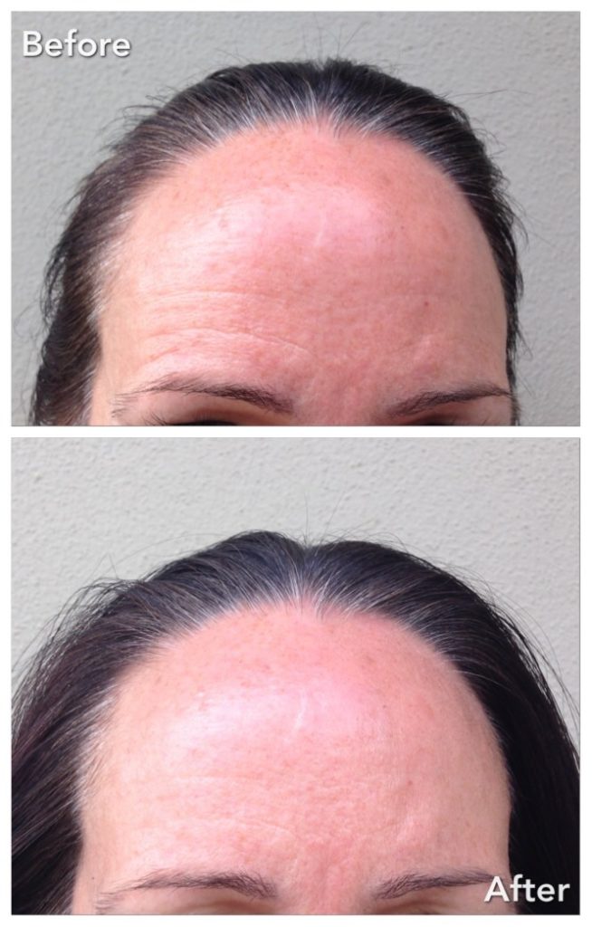 CrystalSmooth Before and After Image Beauty Wire Magazine